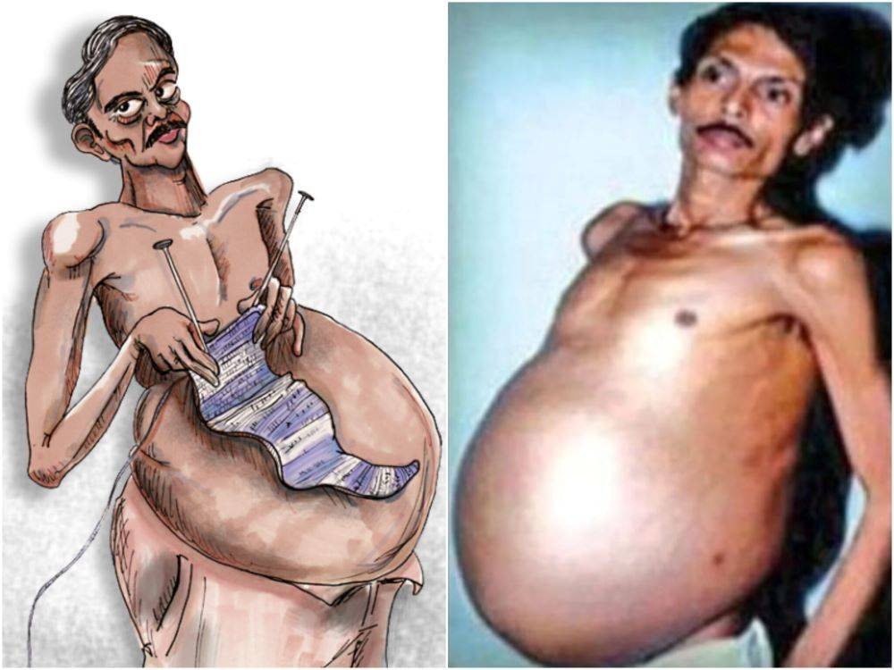 İkiz kardeşini 36 Yıl boyunca karnında taşıyan adamın sıra dışı hikayesini öğrenince şok olacaksınız - Resim: 2