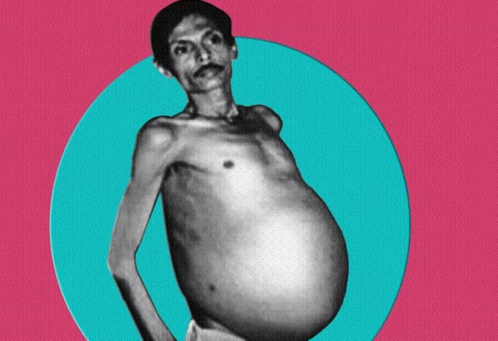 İkiz kardeşini 36 Yıl boyunca karnında taşıyan adamın sıra dışı hikayesini öğrenince şok olacaksınız - Resim: 6