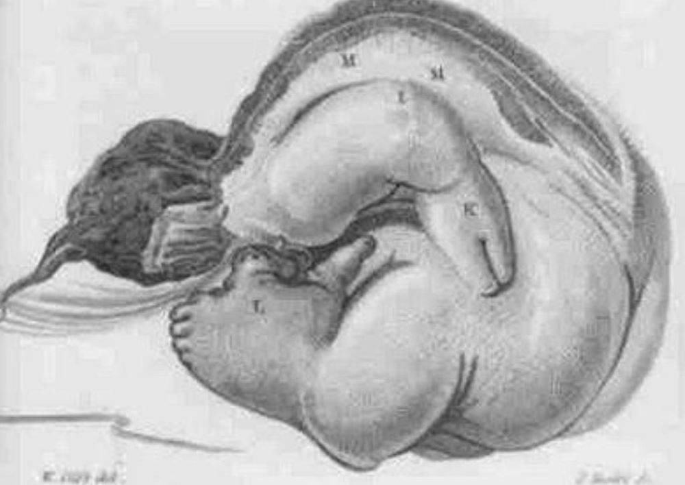 İkiz kardeşini 36 Yıl boyunca karnında taşıyan adamın sıra dışı hikayesini öğrenince şok olacaksınız - Resim: 10