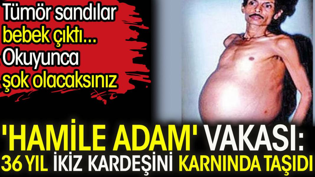 İkiz kardeşini 36 Yıl boyunca karnında taşıyan adamın sıra dışı hikayesini öğrenince şok olacaksınız - Resim: 1