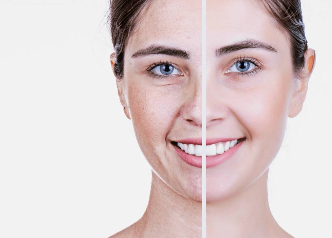 10 yaş gençleşmenin formülü ortaya çıktı. Derin kırışıklıkları ve ince çizgileri yok ediyor - Resim: 1