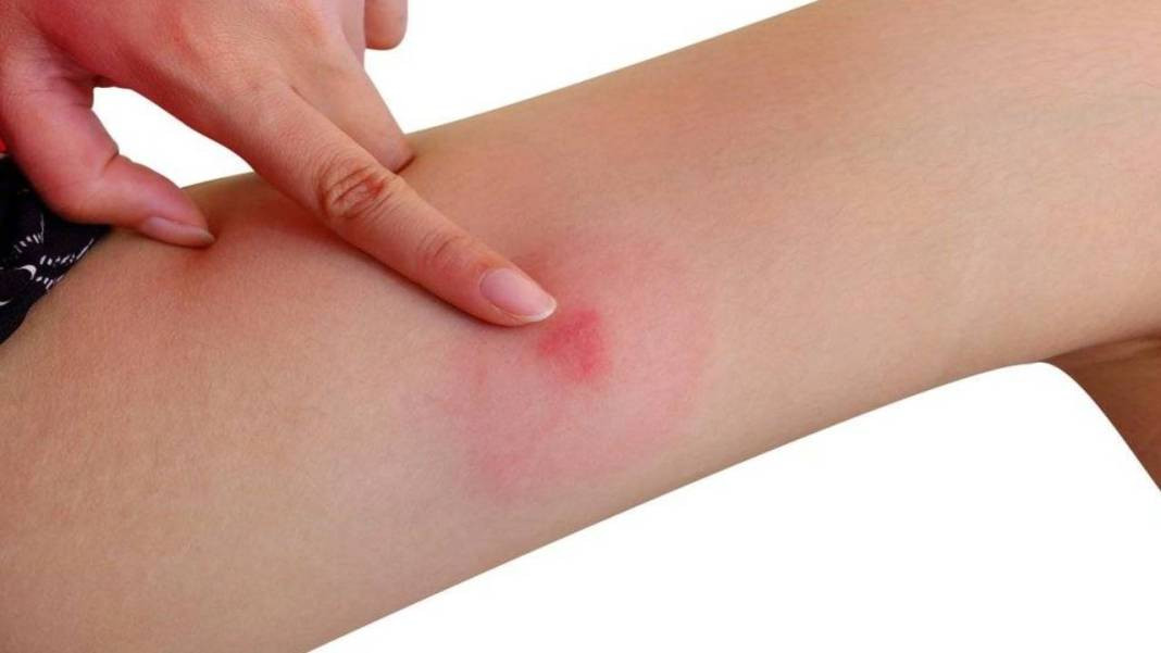 Basit bir ısırık deyip geçmeyin. Organ yetmezliğine kadar gidebilir - Resim: 1