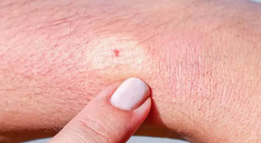 İnsandan insana kan ve vücut sıvılarıyla bulaşıyor. Uzmanlardan o şehirlerde yaşayanlara kritik uyarı - Resim: 7