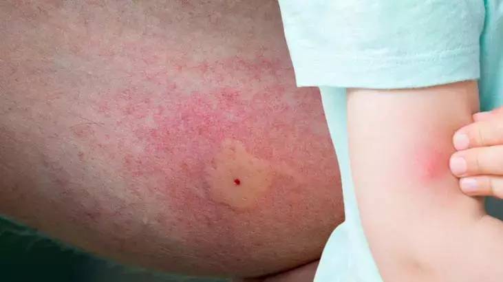 Basit bir ısırık deyip geçmeyin. Organ yetmezliğine kadar gidebilir - Resim: 7