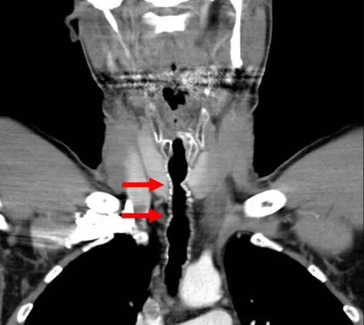 Sigara umulmadık yerinde saç çıkarttı! Doktorların nutku tutuldu - Resim: 4