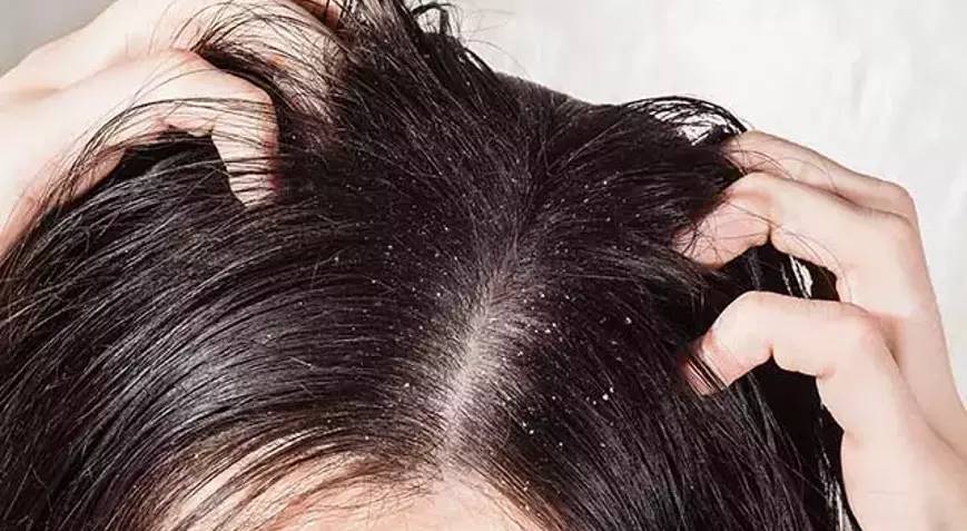 Saç diplerindeki kaşıntıya son. Mucizevi yöntem ortaya çıktı - Resim: 14