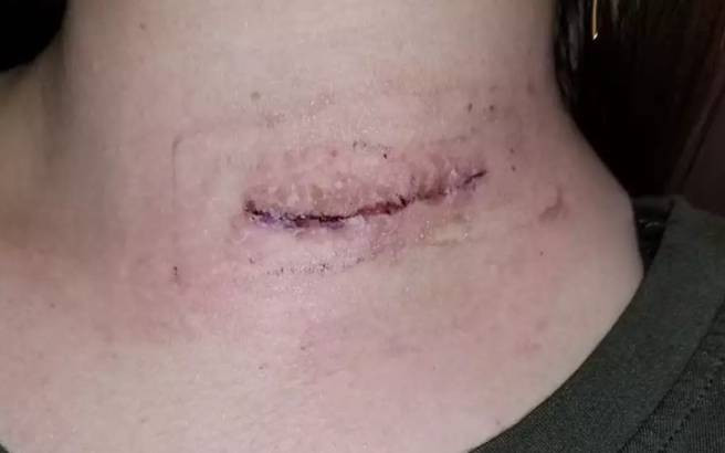 Bir parça tavuk yedi sesini kaybetti. Mangal yaparken dikkat - Resim: 6