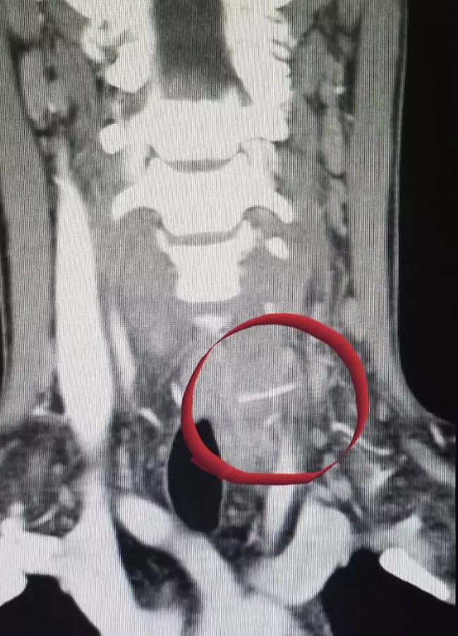 Bir parça tavuk yedi sesini kaybetti. Mangal yaparken dikkat - Resim: 8