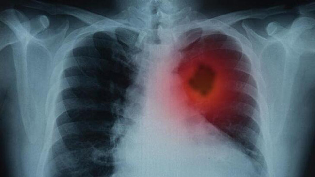 Bu belirtilere dikkat. Ölümcül olabilir - Resim: 2