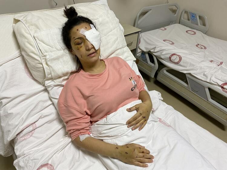 Mehtap öğretmen gözünü kaybetti! Eşinin kardeşi canavarca saldırdı - Resim: 7