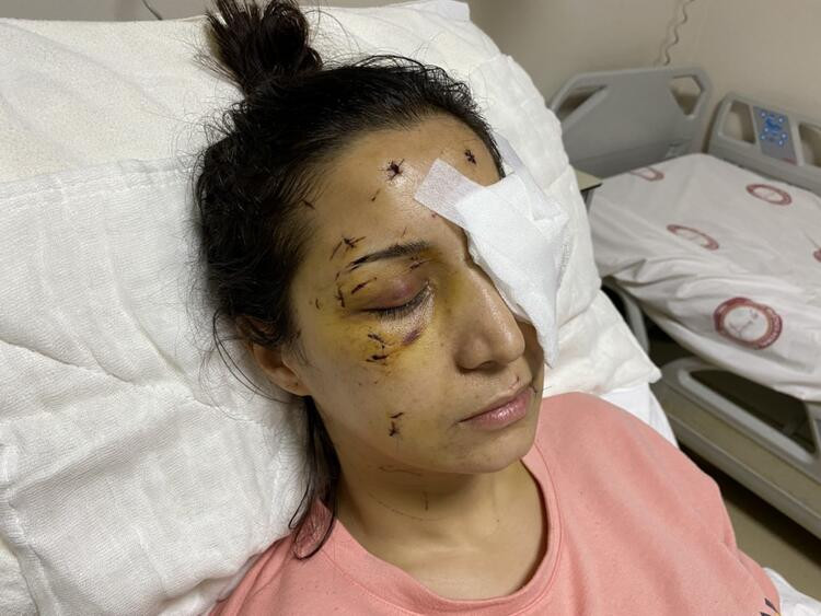 Mehtap öğretmen gözünü kaybetti! Eşinin kardeşi canavarca saldırdı - Resim: 2