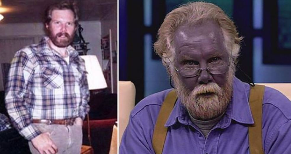 Mavi Adam ve Şirin Baba lakapları takıldı. Kocakarı ilacı yaptı rengi maviye döndü - Resim: 9