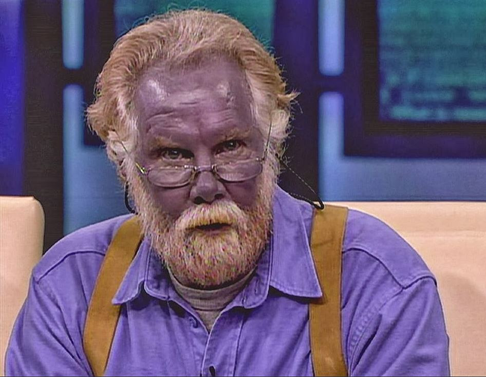 Mavi Adam ve Şirin Baba lakapları takıldı. Kocakarı ilacı yaptı rengi maviye döndü - Resim: 10